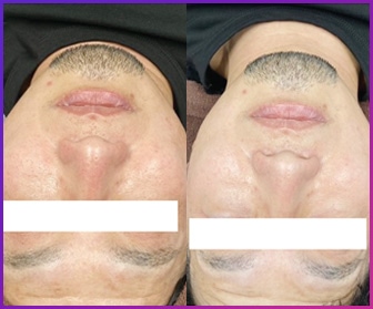 フェイス施術例03